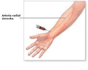 Gasometría en arterial radial